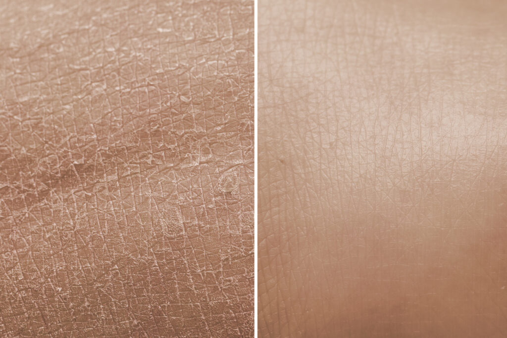 Dry skin patch before and after moisturizing.